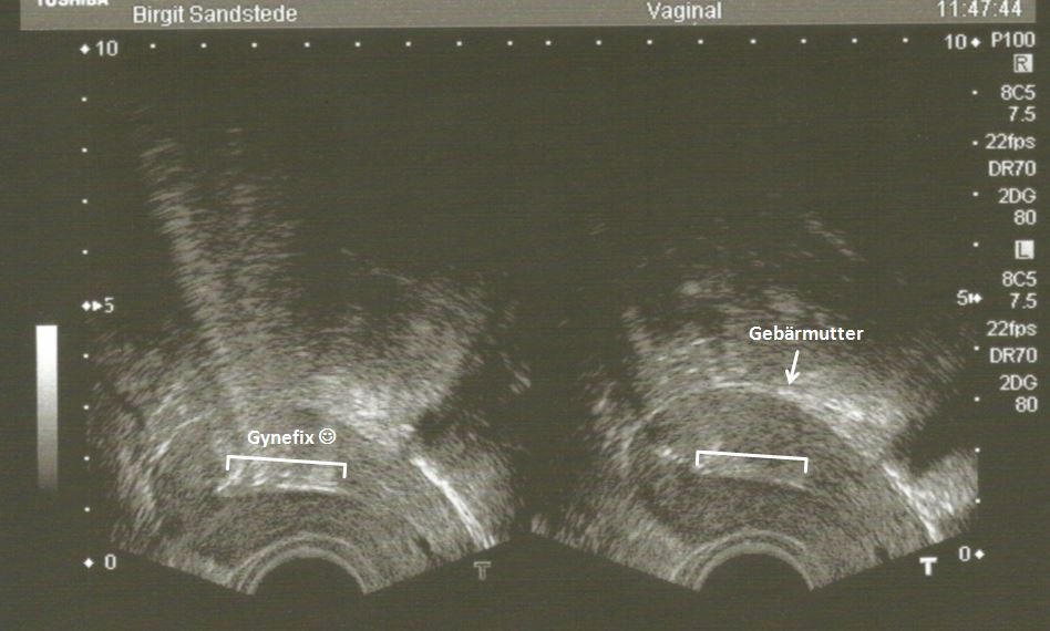Mein erstes Ultraschallbild… es ist eine Gynefix ;-)