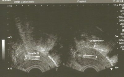 Mein erstes Ultraschallbild… es ist eine Gynefix ;-)